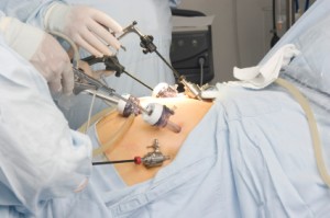 Bariatric Gastric surgery