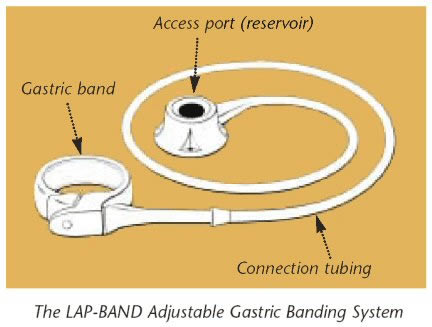 gastric lap band
