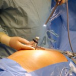 bariatric lap band operation